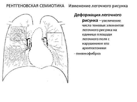 Диагностика диффузной деформации легочного рисунка