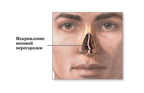 Диагностика искривления носовой перегородки у ребенка