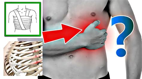 Диагностика и обследование при подозрении на сломанное ребро