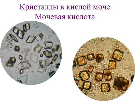 Диагностика кристаллов в моче: основные методы и их надежность