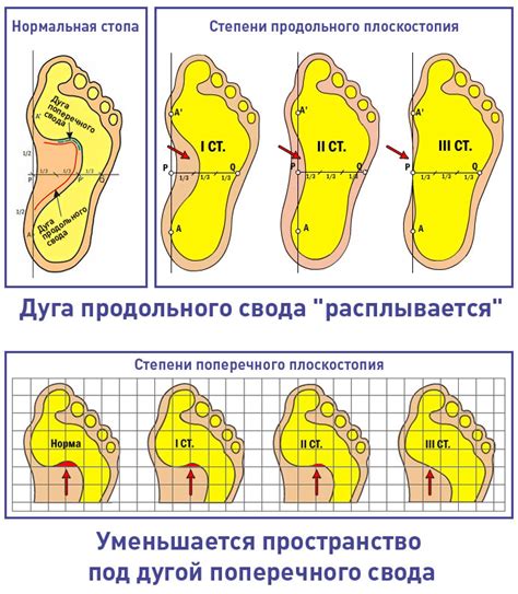 Диагностика плосковальгусных стоп у детей