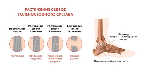 Диагностика разрыва связок на голеностопе