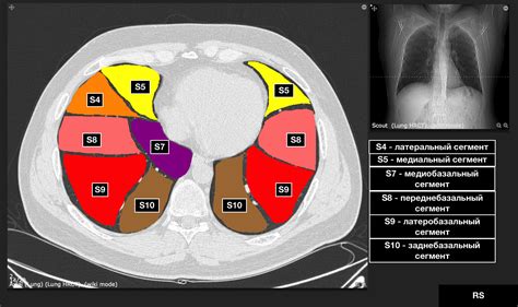 Диагностика S6 правого легкого на КТ