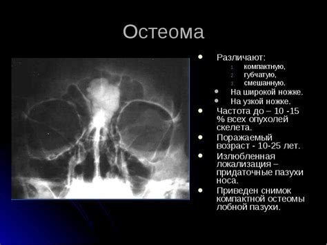 Диагностические методы для идентификации затемнений лобных пазух