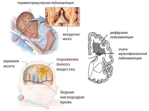 Диета, полезная при гипоксии головного мозга у ребенка