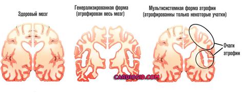 Диффузная кортикальная атрофия 1 степени