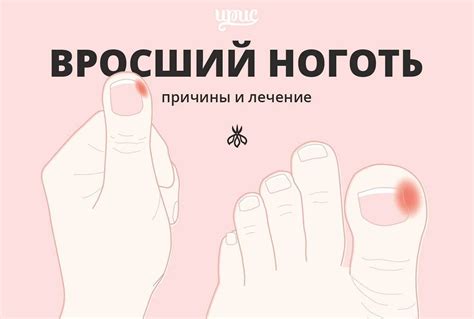 Домашние методы лечения трещины ногтя