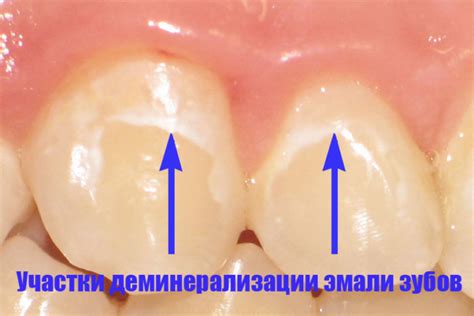 Домашние методы разбавления эмали: