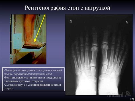 Достоверность результатов рентген стопа с нагрузкой