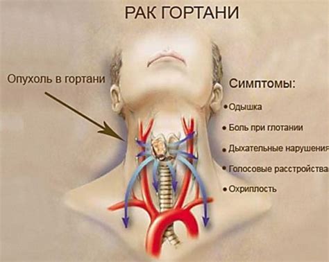 Заболевания гортани