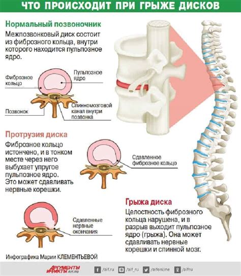 Защита позвоночника и межпозвоночных дисков