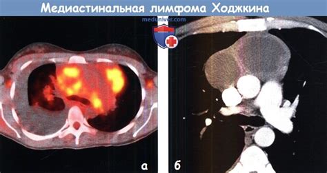 Значение КТ-исследования для своевременного выявления проблем со лимфатическими узлами средостения