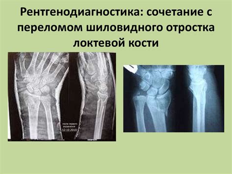 Значение шиловидного отростка локтевой кости