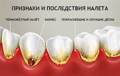 Зубной налет и кариес