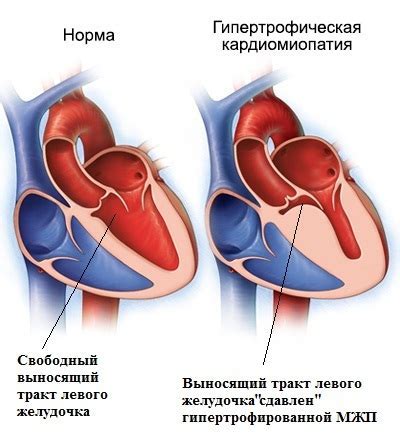 Изменение миокарда левого желудочка: причины, симптомы и лечение