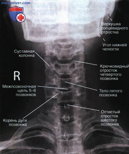 Изменение положения шейных позвонков