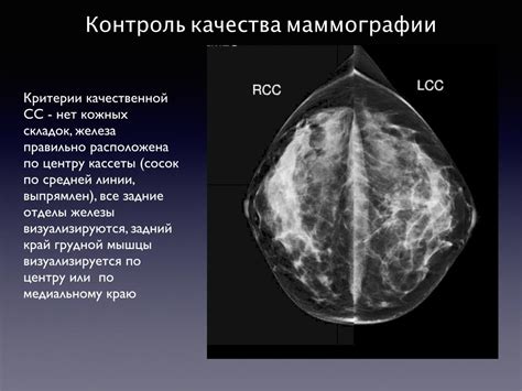 Исходные данные при маммографии