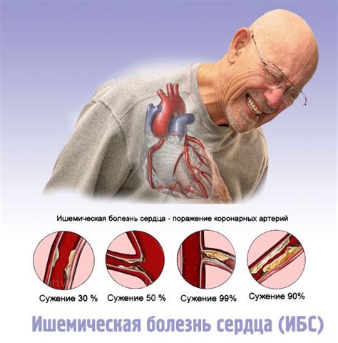 Ишемия: определение, причины и симптомы