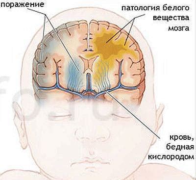 Ишемия головного мозга у детей