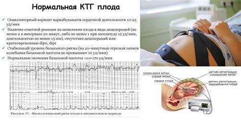 КТГ: что это такое и как проводится