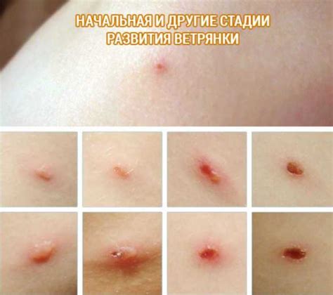 Какая инфекция может проникнуть через лопнутый волдырь при ветрянке