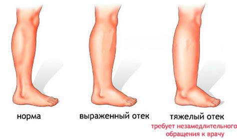 Какие заболевания могут вызывать отечность голени?