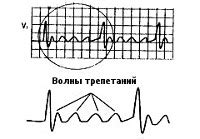 Какие методы лечения трепетания предсердий?