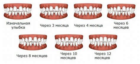 Какие последствия возникают при неправильном использовании брекетов