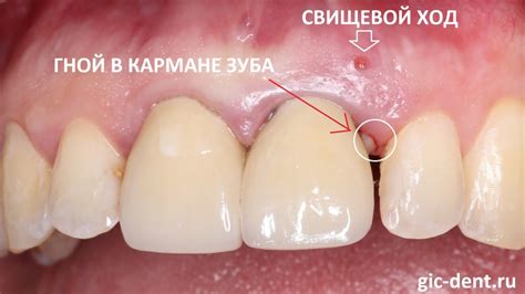 Какие симптомы свидетельствуют о свище на десне