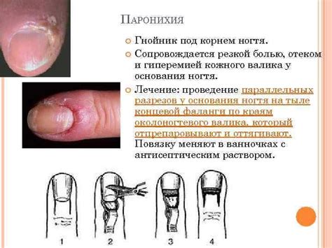 Какие симптомы сопровождают воспаление ногтевого валика на ноге?