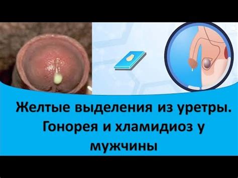 Какие симптомы чаще всего сопровождают желтые выделения