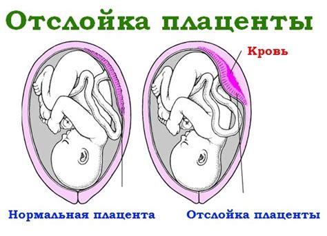 Каковы последствия отслойки хориона