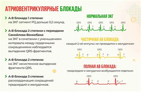 Как блокада отображается на ЭКГ?