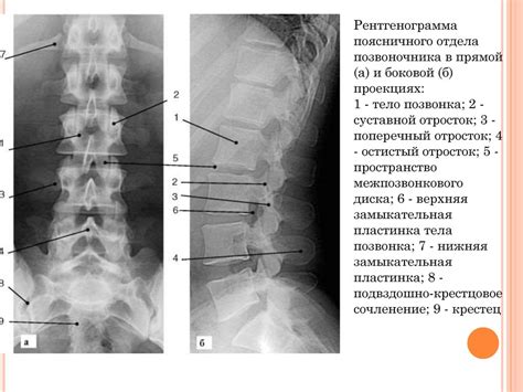 Как выполняется рентгенография поясничного отдела позвоночника