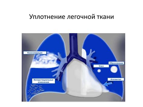 Как диагностировать консолидацию легочной ткани?