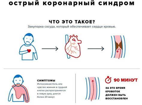 Как диагностируется коронарный синдром?