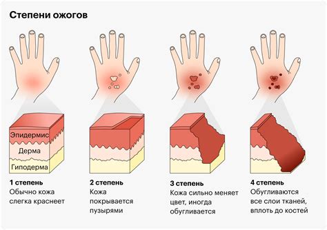 Как избежать ожога от веррукацида