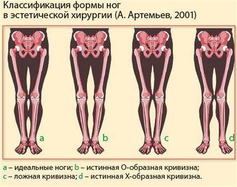 Как исправить положение ноги