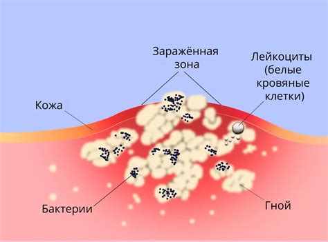 Как минимизировать воспаление