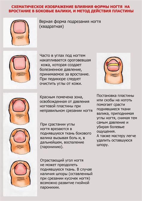 Как определить гноение после удаления вросшего ногтя?