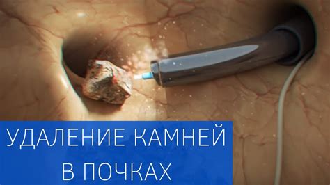 Как определить размер и местонахождение камня в почках