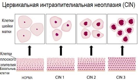 Как отсутствие атипии влияет на диагностику?