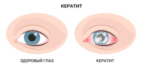 Как понять, что истечение глаз - симптом болезни