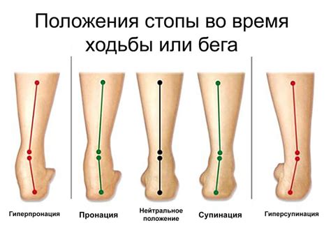 Как правильно выбрать обувь при кривых ногах в коленях?