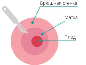 Как предотвратить повторное возникновение спайки на легком?