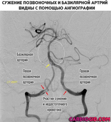 Как проводится церебральная ангиография?