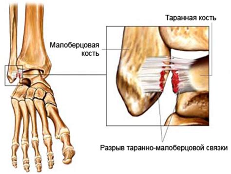 Как производится диагностика растяжения связок на ноге