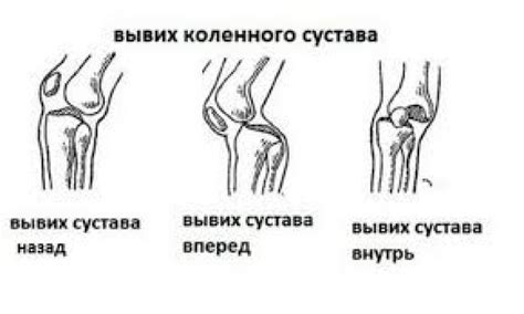 Как происходит вывих колена?