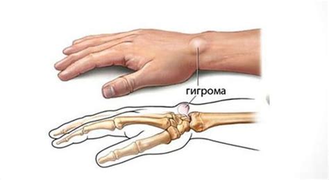 Как происходит лечение отека левой руки в запястье?