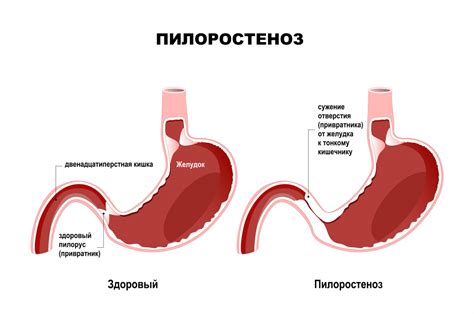 Как проявляется рвота при ацетоне?